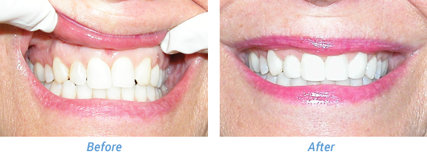 Before and After Patient 1 at Friedman Family & Cosmetic Dentistry in Westfield, IN