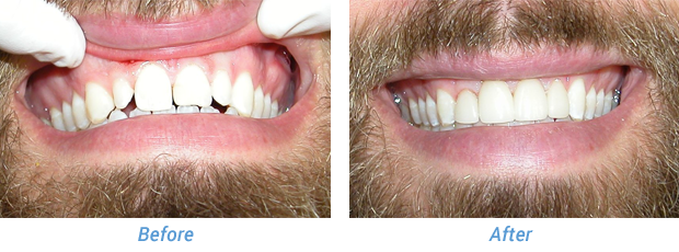 Before and After Patient 2 at Friedman Family & Cosmetic Dentistry in Westfield, IN