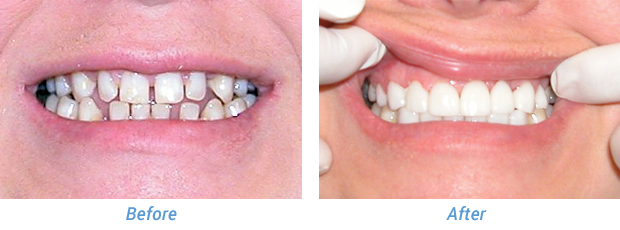 Before and After Patient 3 at Friedman Family & Cosmetic Dentistry in Westfield, IN
