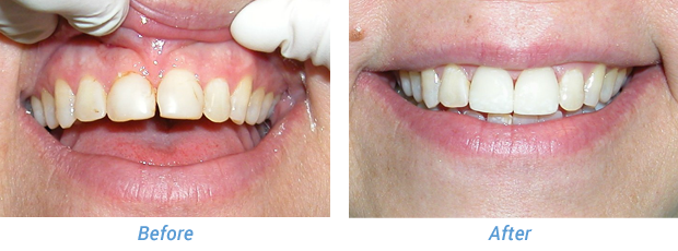 Before and After Patient 4 at Friedman Family & Cosmetic Dentistry in Westfield, IN