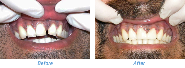 Before and After Patient 5 at Friedman Family & Cosmetic Dentistry in Westfield, IN