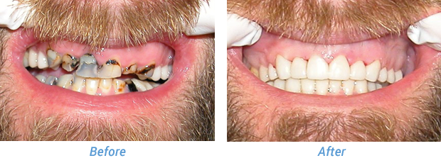 Before and After Patient 6 at Friedman Family & Cosmetic Dentistry in Westfield, IN
